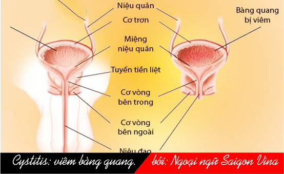 Cyst và cystalgia, saigonvina