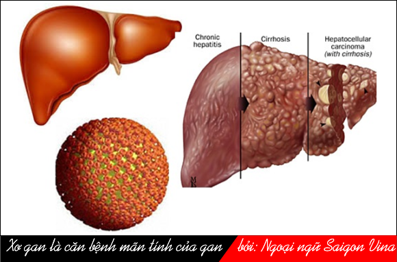 Cirrhosis, cochlea và colitis, saigonvina