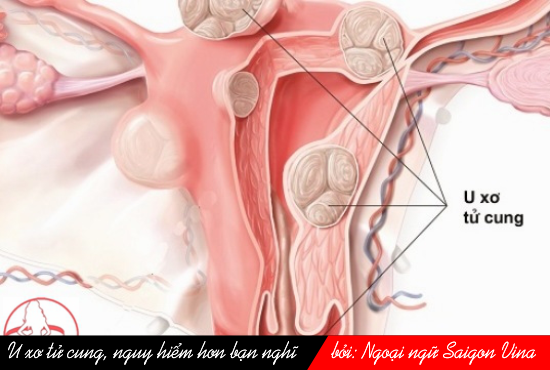 fibroma